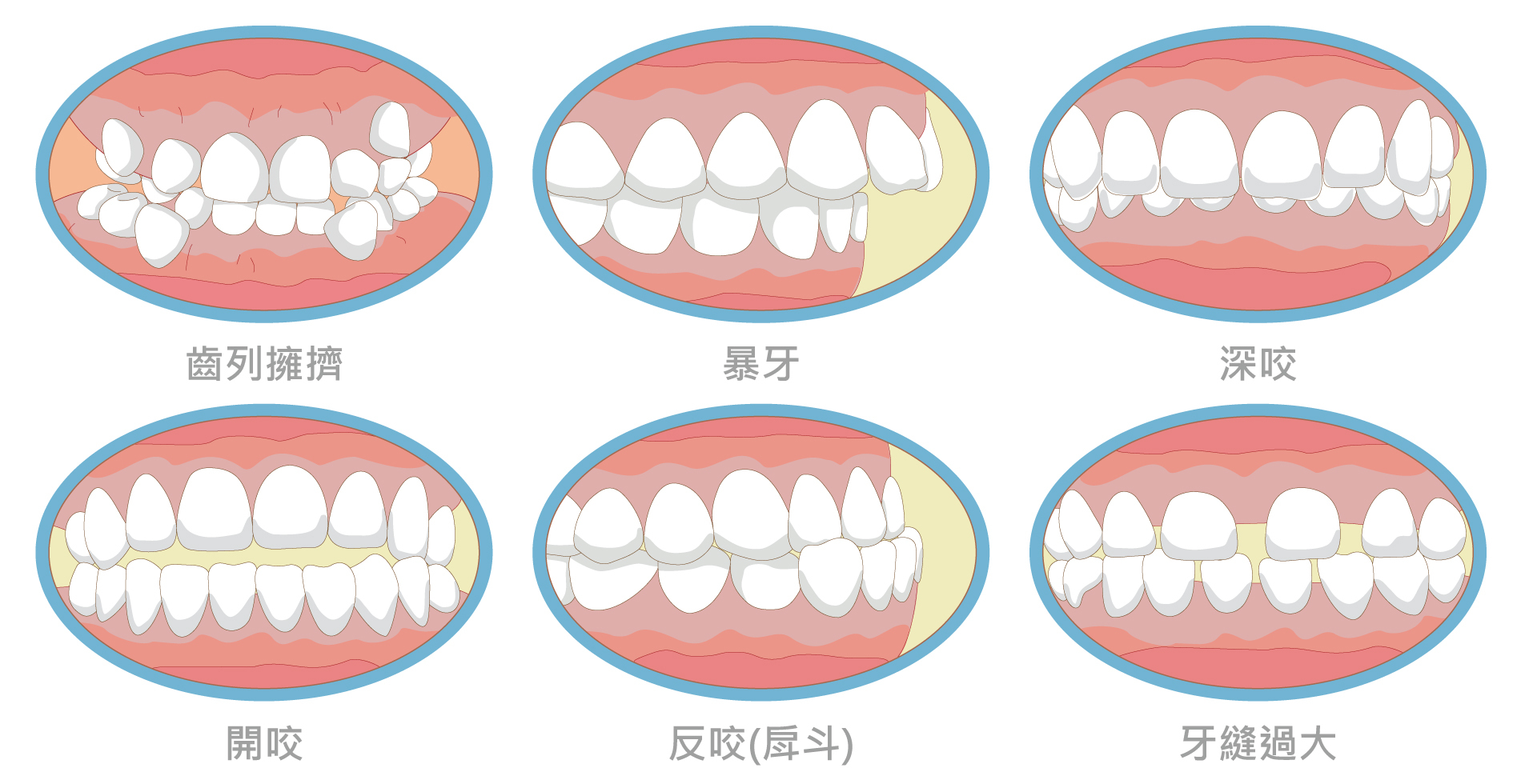矯正-02